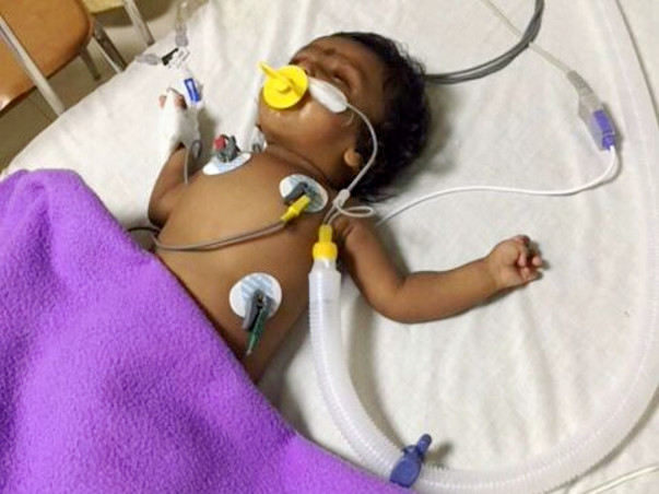 Help 3 Month Old Baby Angela For Heart Surgery