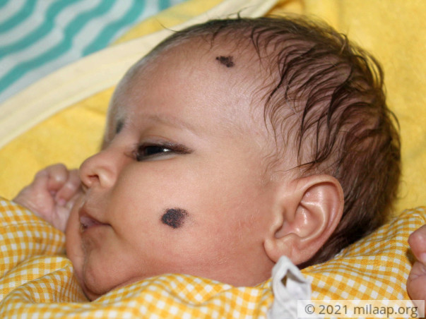 2-Month-Old Baby's Enlarged Liver Will Kill Her Without Urgent Help
