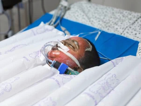 50% Of This Baby’s Body Is Burnt And He’s Struggling To Live