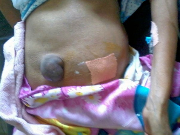 Mother's treatment liver cirrhosis
