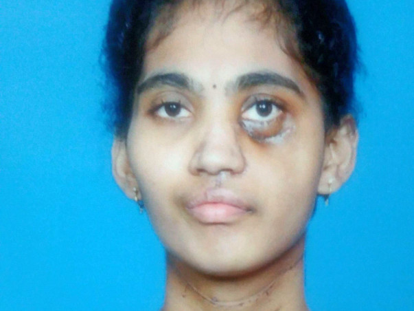 Help Jyothi undergo radiotherapy