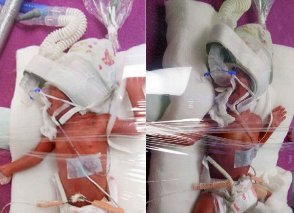 Help My New Born Twins Fight Battle Of Life