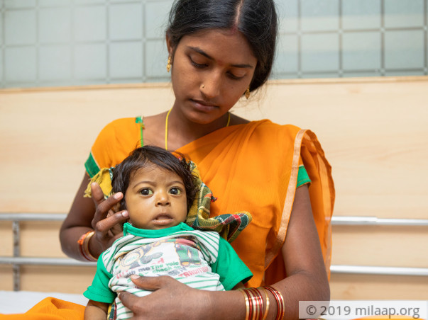 Baby of Sarojini Biliary Atresia with Chronic Liver Disease