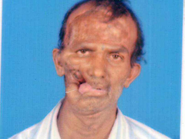 Help this 48-year-old fisherman with facial deformity
