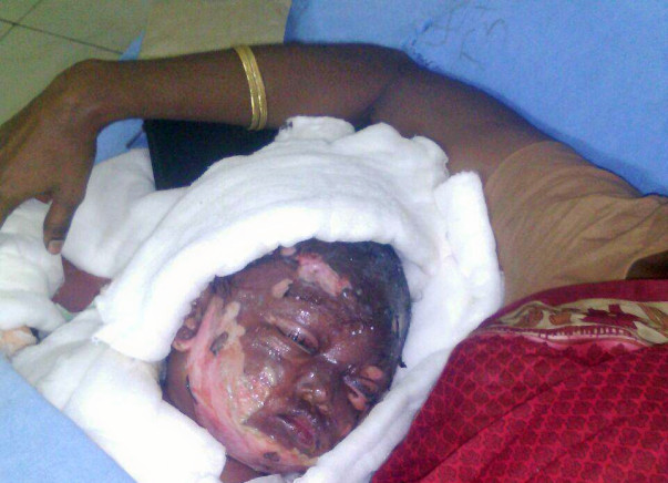 Help this 16 month old baby girl who is suffered serious burns.