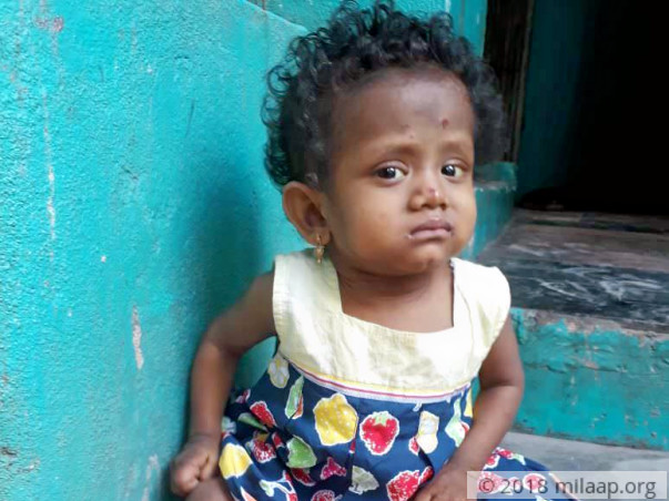 Help Baby Joshna Fight A Painful And Fatal Liver Disease