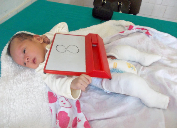 I am fundraising to help treat clubfoot in babies