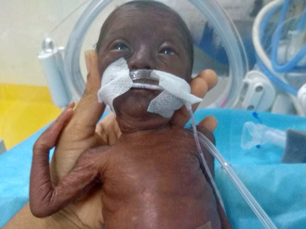 Help Premature Baby To Live