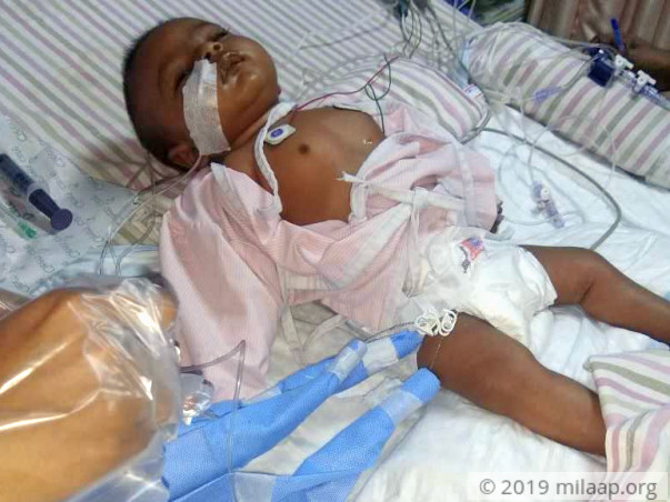 1-Year-Old Baby Girl Needs An Urgent Liver Transplant To Survive