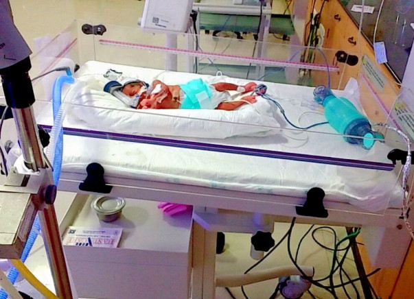 Help My Premature Baby For Survival