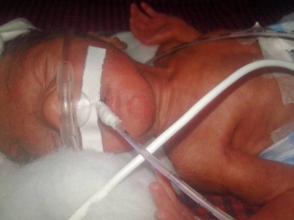 Help premature baby boy