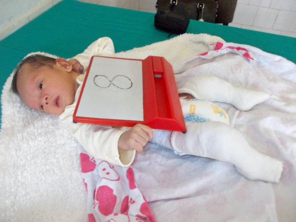 I am fundraising to help treat clubfoot in babies