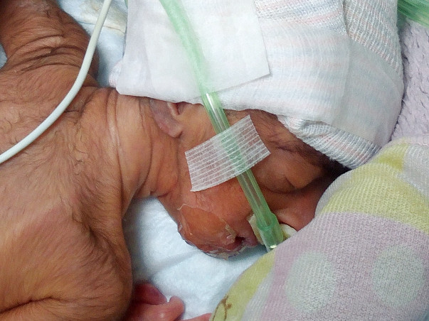 Help for my premature baby of low birth weight due to born at 28 weeks