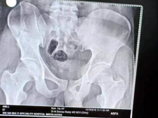 Help anil to survive from the accident
