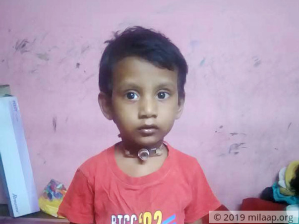 Help Yogesh Recover From Post Intubation Tracheal Stenosis