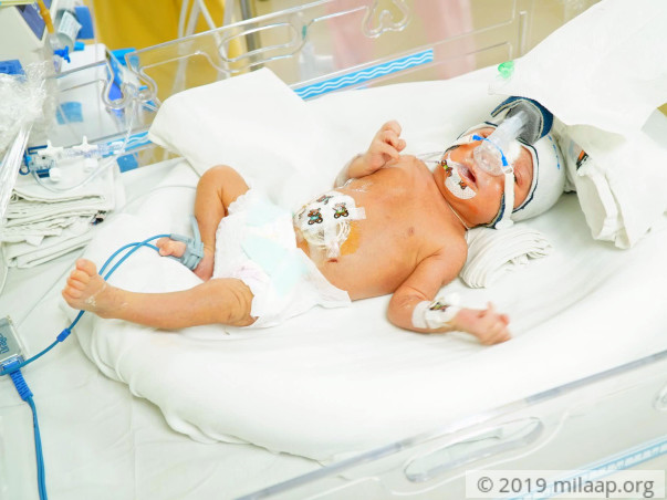 Baby of Teeja needs your help to survive