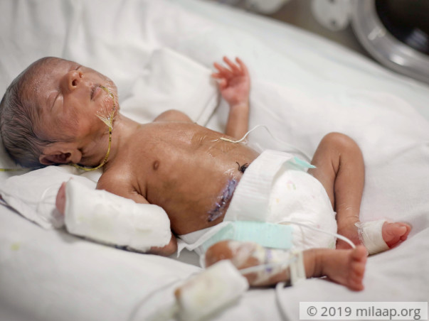 16-Day-Old Premature Baby Needs To Stay In The NICU To Survive