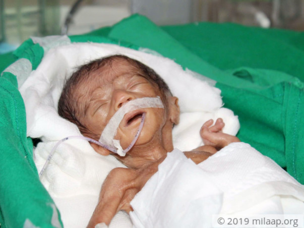 This Fragile Newborn Twin Is Just 580 grams And Is Fighting To Live