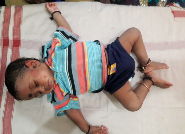Help Vignesh Fight Intestinal Lymphangiectasia