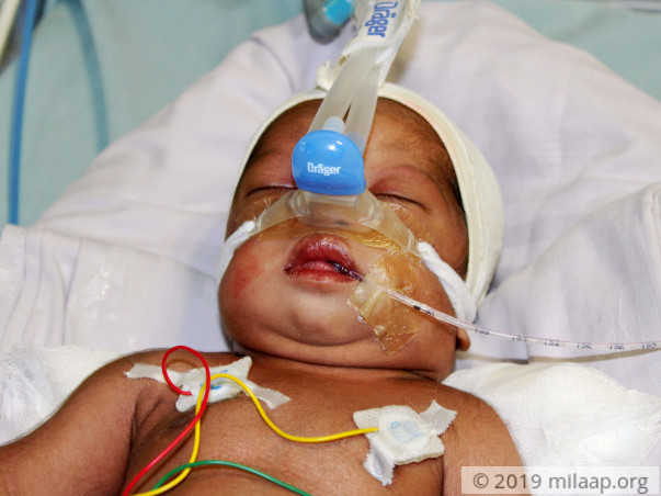 10-Day-Old Baby With A Damaged Brain And Failing Heart Needs Help