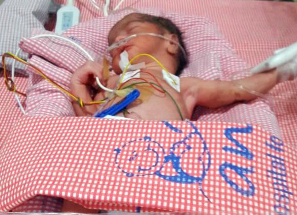 Help To Save The Life Of 3 Weeks Old Premature Born Twins