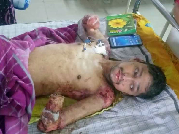 Help My Friend Zameer Recover From Fire Accident
