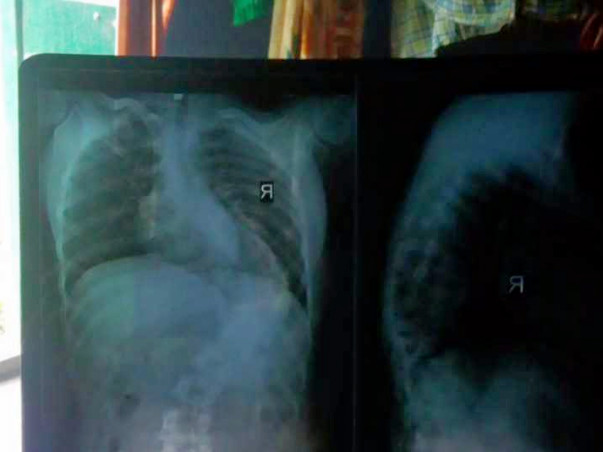 Help Tanuja fight scoliosis