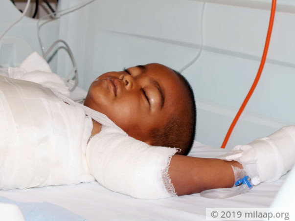 Boy Who Accidentally Fell Into A Vessel Of Boiling Milk Needs Help