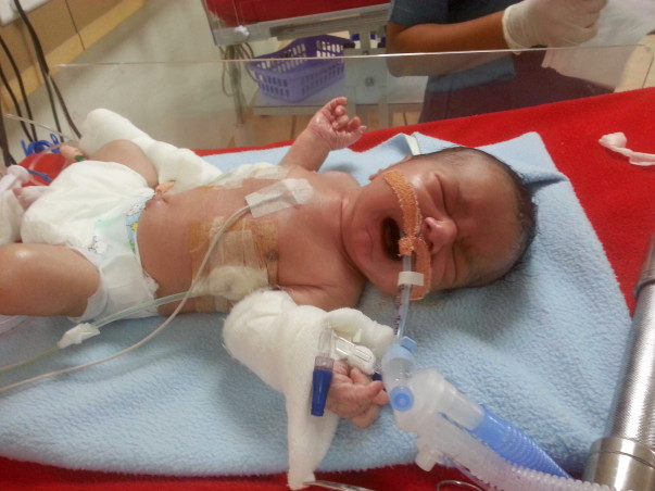 Help This Premature Baby Get Ventilator Support