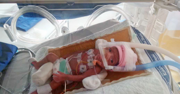 They Did Not Think She Would Survive But This 1 2kg Baby Girl Is A Fighter Milaap