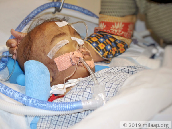 Help 1-Year-Old Arush beat Pneumonia and come out of the ICU alive
