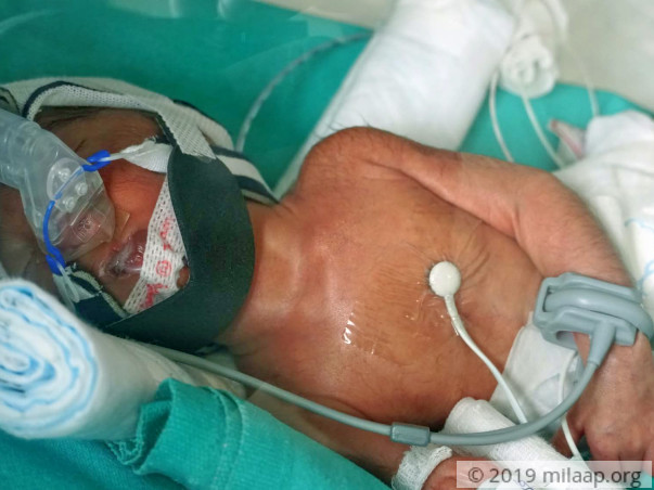 Help Mamatha's Premature Baby