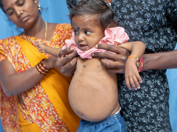 If Baby Lokesh does not get a new liver soon, he may not survive