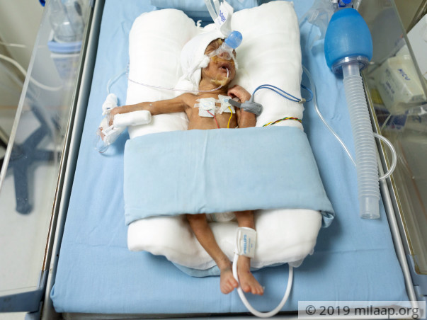 Help Jyothi's Premature Twins