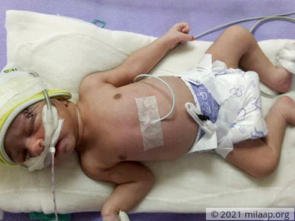 Help Baby of Mosarrat Survive
