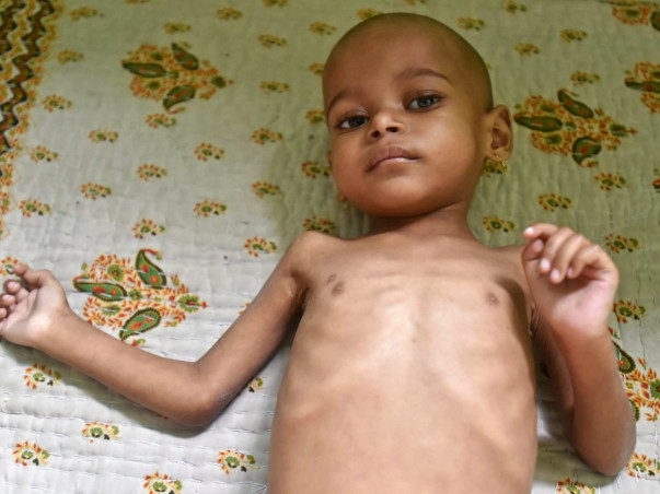 He’s The Only Child In India With This Deadly Disease, He Needs Help