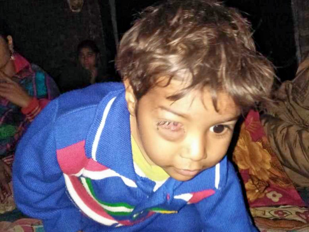 Support 2 Year Old Mohd. Saad Fighting With Cell Tumor On His Eye