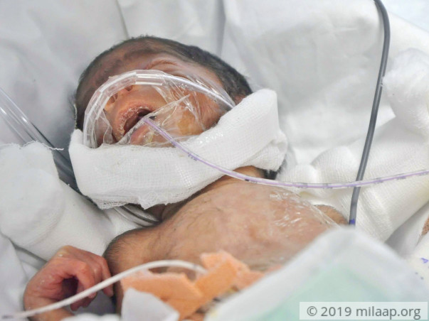Baby of Dakshayini needs your help to survive