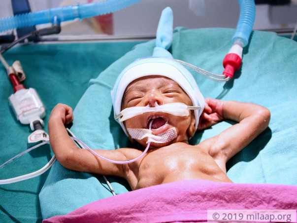 Within Seconds Of His Birth, This Baby Was Fighting For His Life
