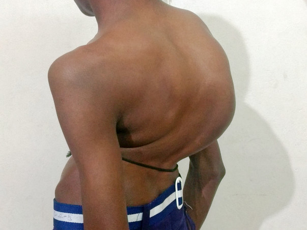 Help Shivakumar Recover from Spinal Cord Disorder