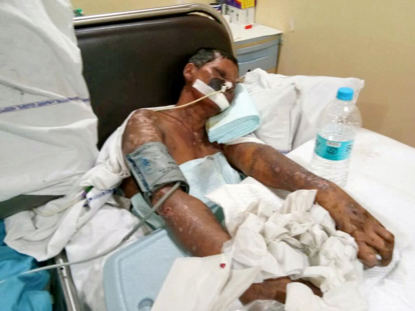 40-year-old Shevanta urgently needs treatment for severe skin disease
