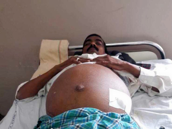 Please Help Me Raise Funds For My Father's Liver Transplantation