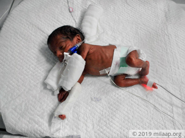 Support Twins of Madhumitha's struggle for life