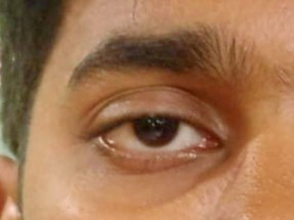 24 yr old Ashish needs help for his eye surgery