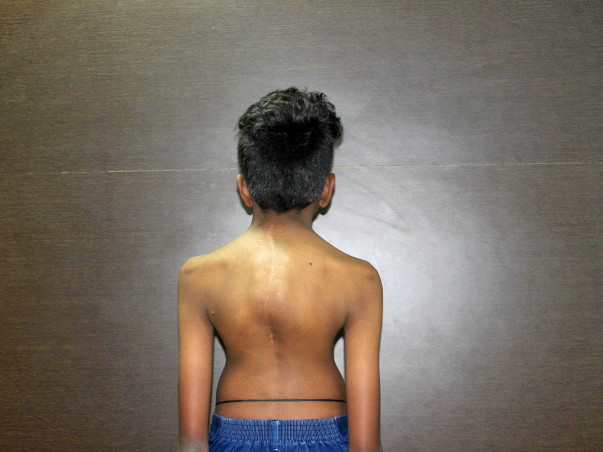 Help 16-year-old Balaji fix his severely deformed spine