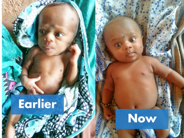 Save lives of 100 malnourished children in Palghar, Maharashtra.