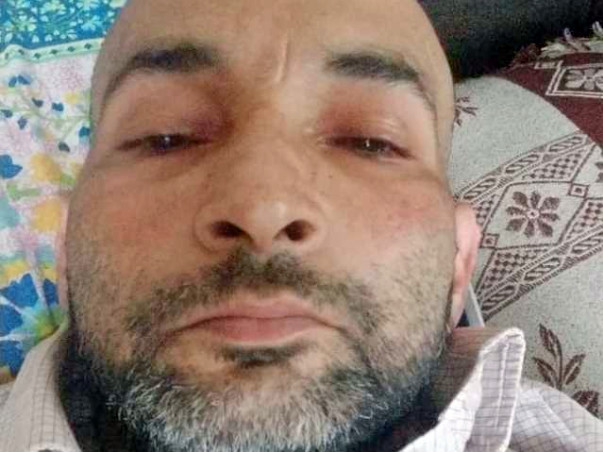 Shardendu Is Fighting Squamous Cell Carcinoma, Help Him.