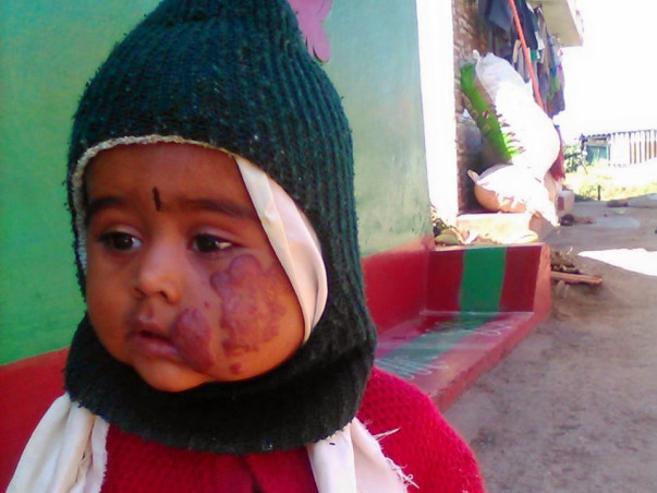 Help My Daughter Recover From Swelling In The Face