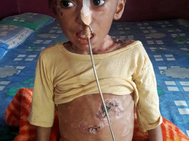 Help This 2-year-old Who Has A Disease That Is Eating Up Her Skin