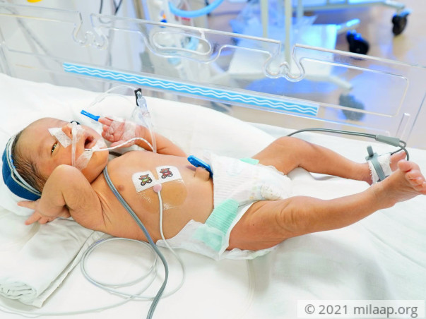 Baby of Renu needs your help to survive
